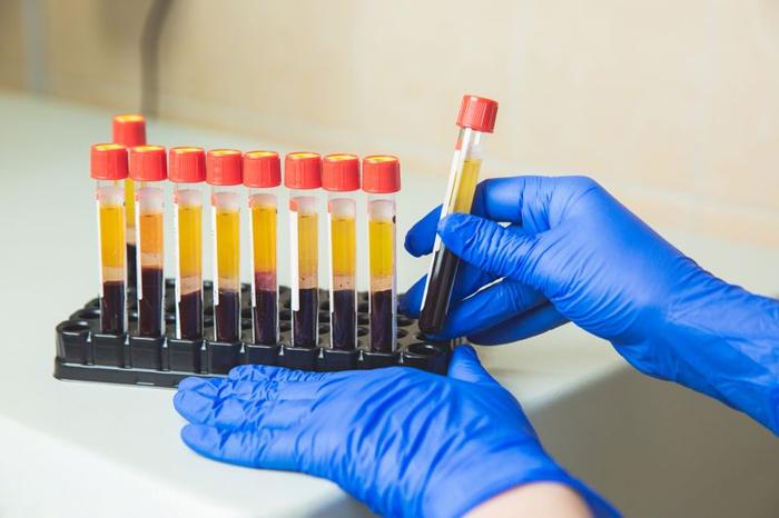 contenitori di test con sangue che è stato centrifugato, in modo che il sangue scuro sia visibile verso il fondo dei tubi e il plasma giallo sia verso l'alto; sono visibili due mani con guanti blu, una delle quali tiene uno dei tubi, che hanno coperchi rossi.