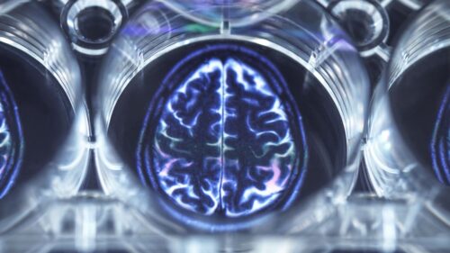 Il cervello umano è diventato più grande negli ultimi 90 anni. Le possibili spiegazioni