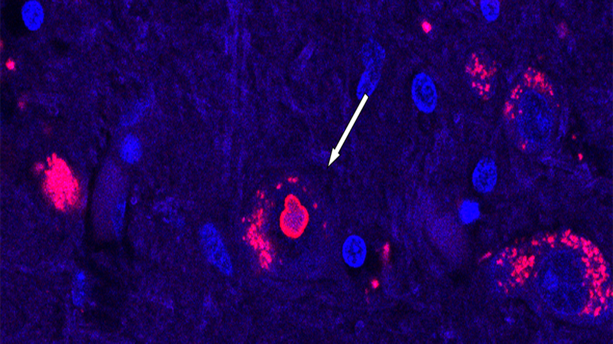 Scoperta la causa di una malattia neurologica rara dopo 25 anni di ricerca