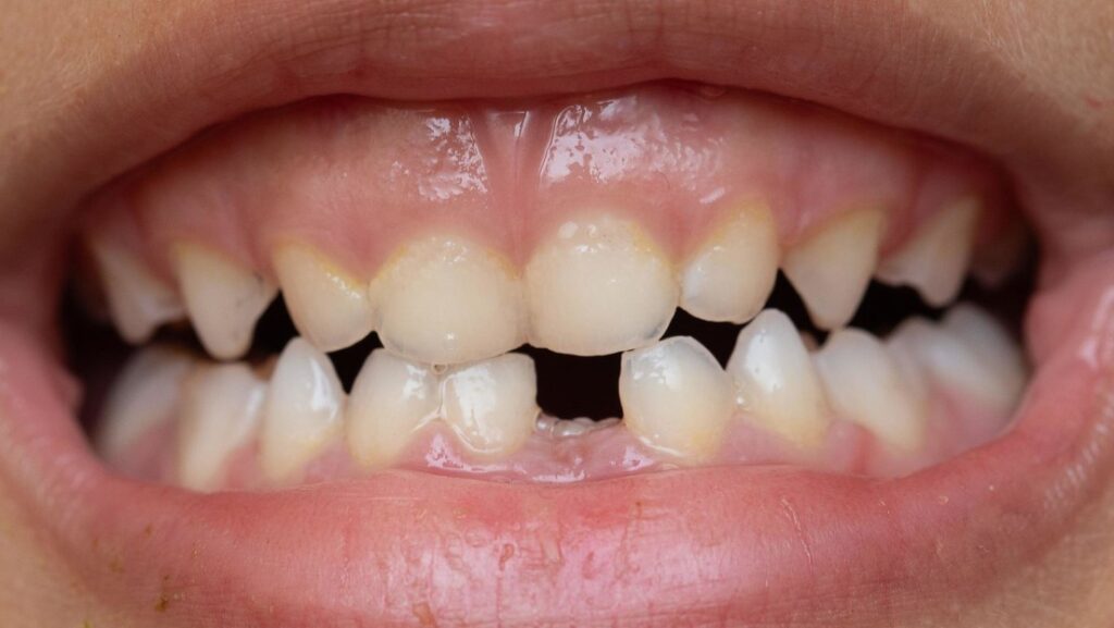 Addio carie? Un nuovo gel potrebbe rigenerare lo smalto dei denti