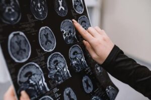 Il Mistero dei Cervelli Resilienti alla Malattia di Alzheimer