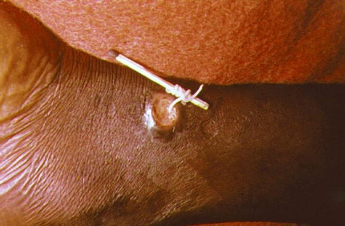 guinea-worm-removal-m-2.jpg