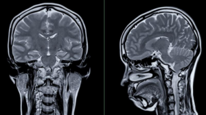 Risonanza magnetica del cervello da dietro e di lato
