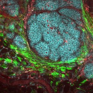 Questa immagine di un tumore al seno e del suo microambiente è stata ottenuta da un modello di topo vivo utilizzando la microscopia a multiphoton e la fluorescenza endogena. Vale a dire, l'immagine è stata ottenuta senza fluorofori, coloranti o tinture, utilizzando solo i co-fattori metabolici di NADH e FAD, che sono già presenti all'interno delle cellule, insieme alla generazione del secondo armonico per vedere il collagene. Questa tecnica ha un importante potenziale clinico per i pazienti che richiedono imaging senza etichetta e potrebbe portare a diagnosi e trattamenti più efficaci. Le cellule tumorali si mostrano in ciano, i macrofagi in rosso, le fibre di collagene in verde.