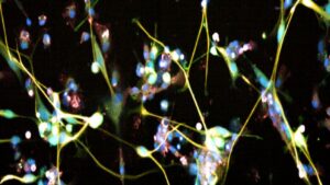 cellule di glioblastoma