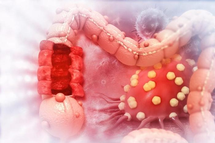 Colon-Cancer-Illustration-777x518-1-1.jpg
