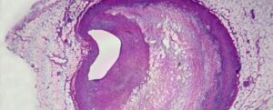 Sezione di tessuto di arteria coronaria occlusa, colorata di viola come osservata al microscopio.