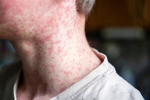 Una foto ravvicinata della gola di un ragazzo che mostra la eruzione cutanea del morbillo che copre la maggior parte del suo collo e del viso inferiore. La foto è limitata solo a questa parte del suo corpo, ma mostra quanto sia estesa l'eruzione cutanea.