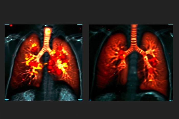 Lung-Function-MRI-Art-Concept-777x518-1-1.jpg