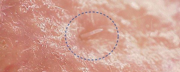 demodex-under-the-microscope-in-human-skin_600-1.jpg