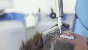 Un'immagine di un medico che utilizza Rhenium-SCT su un paziente con cancro della pelle non melanoma