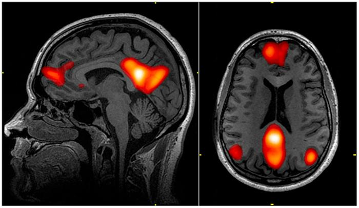 Immagini di scansione cerebrale con la rete in modalità predefinita evidenziata