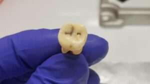 Il DNA antico risolve il mistero di 1.500 anni che ha causato ‘la prima pandemia del mondo’