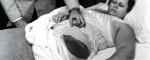 Il primo impatto di meteorite umano registrato è ancora una storia incredibile dopo 70 anni