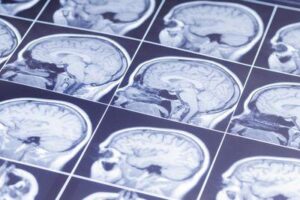 Immagini della risonanza magnetica del cervello umano