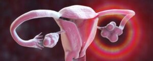 L'isterectomia aumenta significativamente il rischio di ictus, nuove evidenze suggeriscono