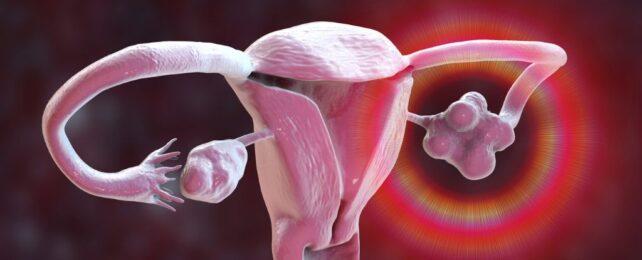 HysterectomyOvaries-642x260-1.jpg