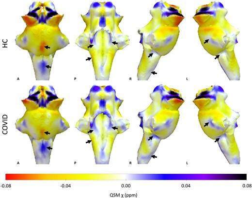 Mappatura dei tronchi encefalici delle differenze nei cervelli sani e nei cervelli con long covid