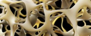 Illustrazione dell'osteoporosi