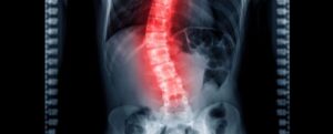 Immagine a raggi X di una colonna vertebrale con una sezione curva che brilla di rosso