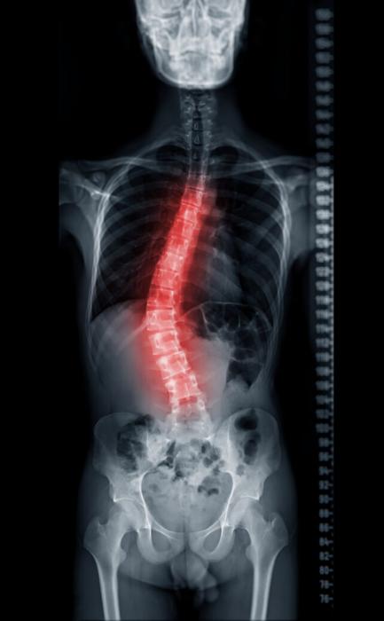 Mal di schiena? Le curve nella tua colonna vertebrale potrebbero essere la causa.