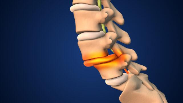 Mal di schiena? Le curve nella tua colonna vertebrale potrebbero essere la causa.