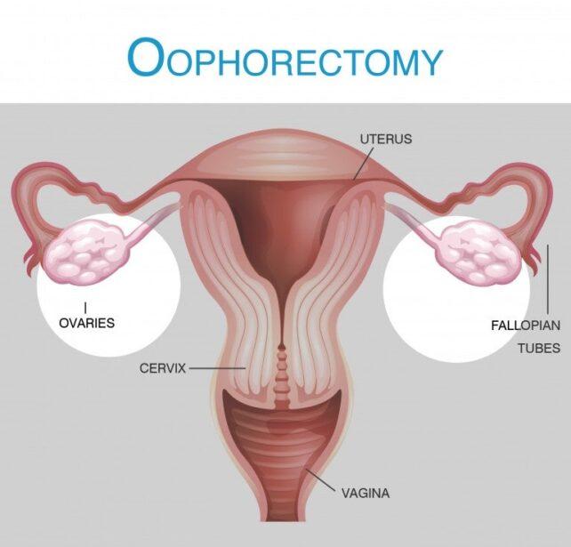 Ooforectomia