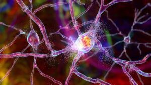 Illustrazione 3D renderizzata della distruzione dei neuroni nello striato dorsale come si vede nella malattia di Huntington