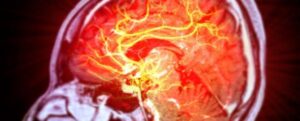 Le cellule staminali riparano i danni cerebrali causati da ictus nei topi
