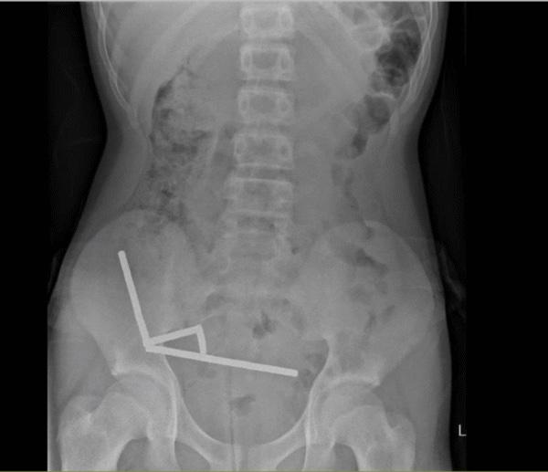 Un adolescente neozelandese perde parte dell'intestino dopo aver ingoiato quasi 200 magneti
