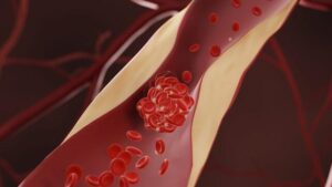 Arterie bloccate grafica