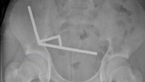 Un adolescente neozelandese perde parte dell'intestino dopo aver ingoiato quasi 200 magneti