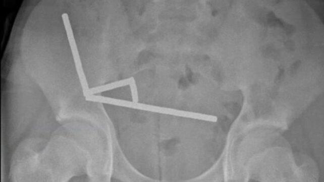 Un adolescente neozelandese perde parte dell'intestino dopo aver ingoiato quasi 200 magneti