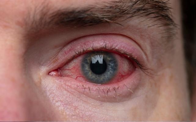 occhi iniettati di sangue