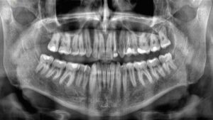 radiografia della bocca