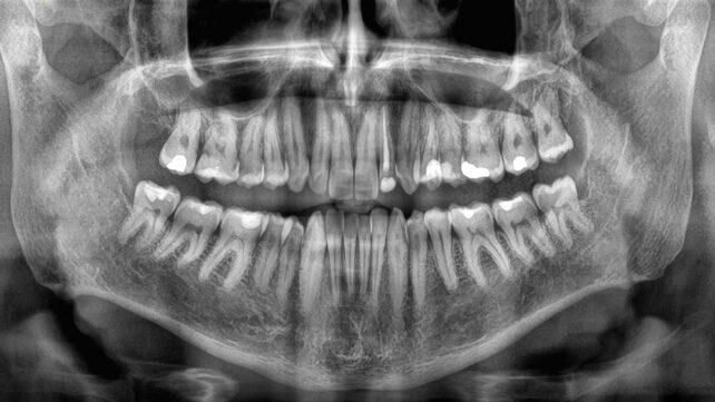 x-ray-of-mouth-642x361-2.jpg