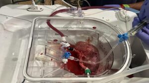 I maiali ricevono i primi trapianti di rene al mondo coltivati con tessuto organoide umano