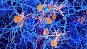 Illustrazione delle placche amiloidi (arancioni) e delle cellule microgliali (rosse) tra i neuroni