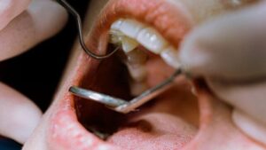 Il trattamento del canale radicolare potrebbe migliorare il controllo della glicemia, suggerisce uno studio