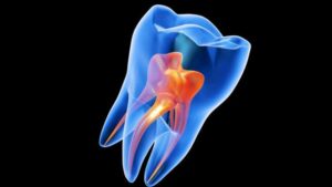 Sezione trasversale trasparente di un dente molare che mostra la camera pulpare in arancione