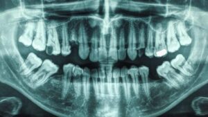 Radiografia dei denti