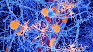 Illustrazione delle placche amiloidi (arancioni) e delle cellule microgliali (rosse) tra i neuroni