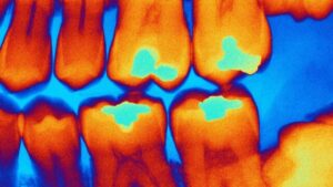 immagine a raggi X colorata di otturazioni dentali nei denti
