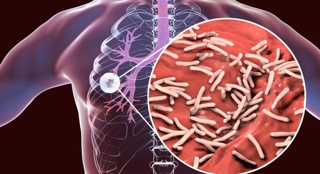 illustrazione della tubercolosi nei polmoni