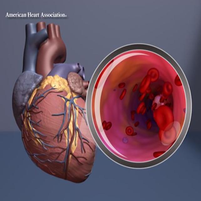 grafica dell'arteria cardiaca