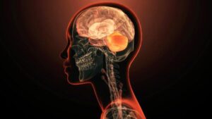 Gli scienziati scoprono il primo gene singolo che causa direttamente malattie mentali