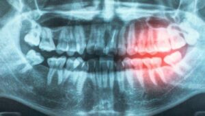 radiografia della bocca