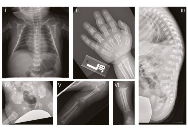 radiografie di un paziente con ssmd