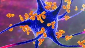 Sostanze chimiche perenni collegate alla sclerosi multipla in un preoccupante nuovo studio