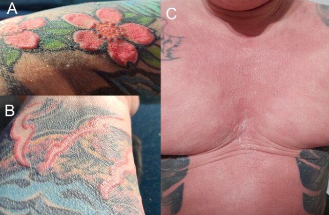 Pannello di tre immagini in primo piano che mostrano reazioni cutanee rosse e sollevate sulla pelle pigmentata di un tatuaggio sul braccio e sul petto dell'uomo.